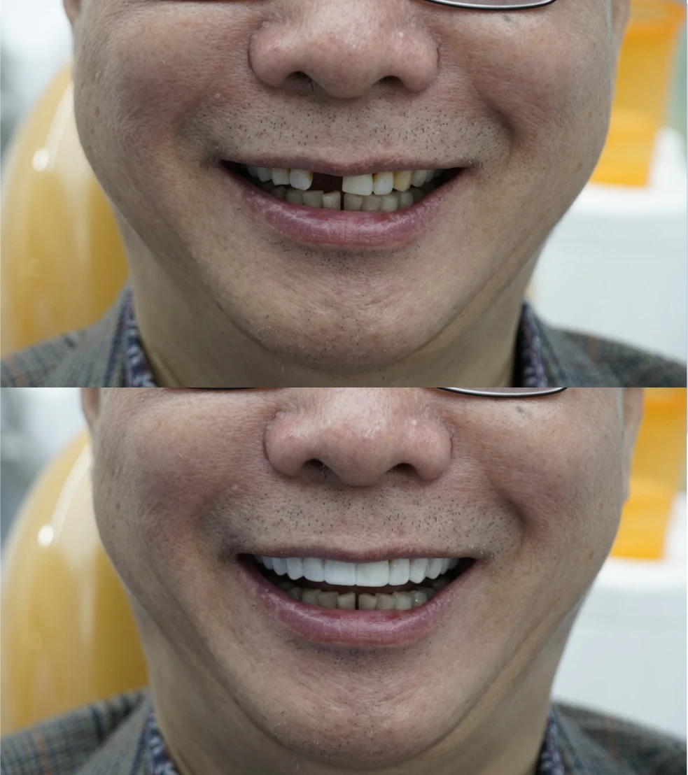 Before and after picture of smile makeover done at Rekha's Dental Care