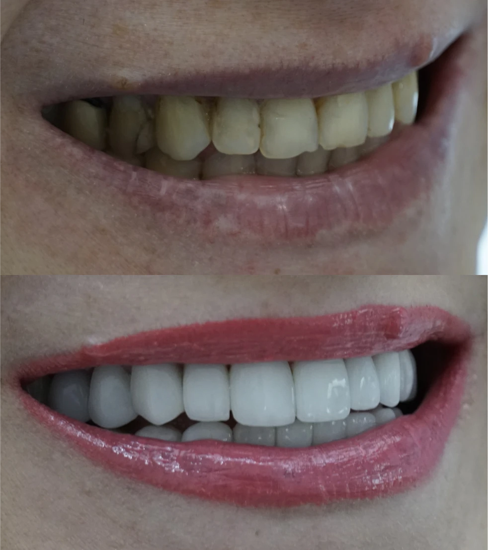 Teeth Whitening treatment at Rekhas will make you smile brighter