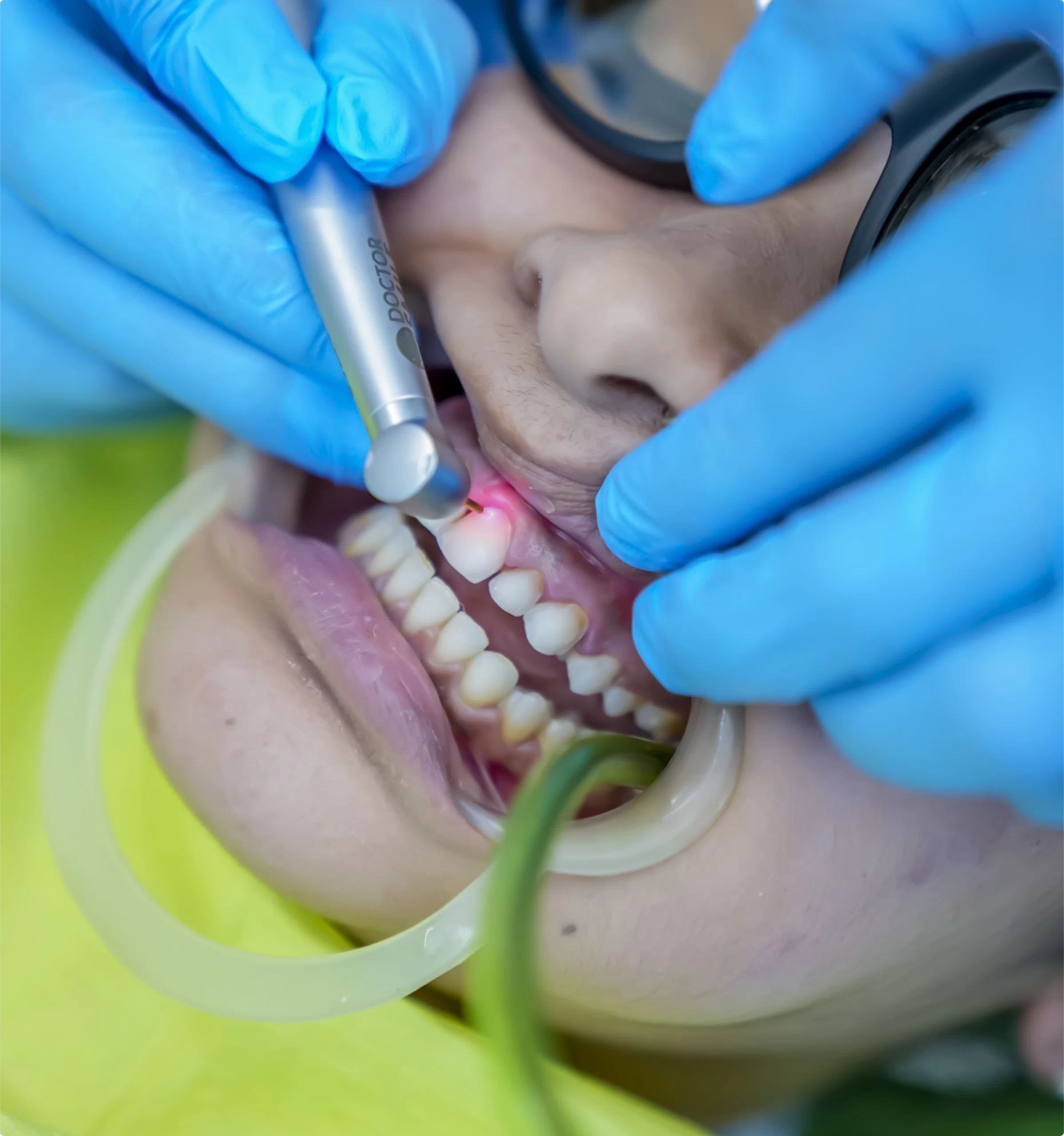 Laser Gum Treatment at Rekhas Dental Care