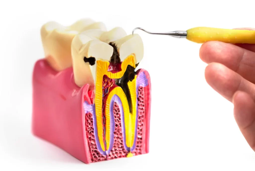 Dental cavity and Tooth Decay - Visit Rekhas for immediate dental needs