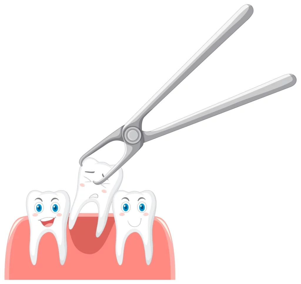 Tooth extraction - dental cavity