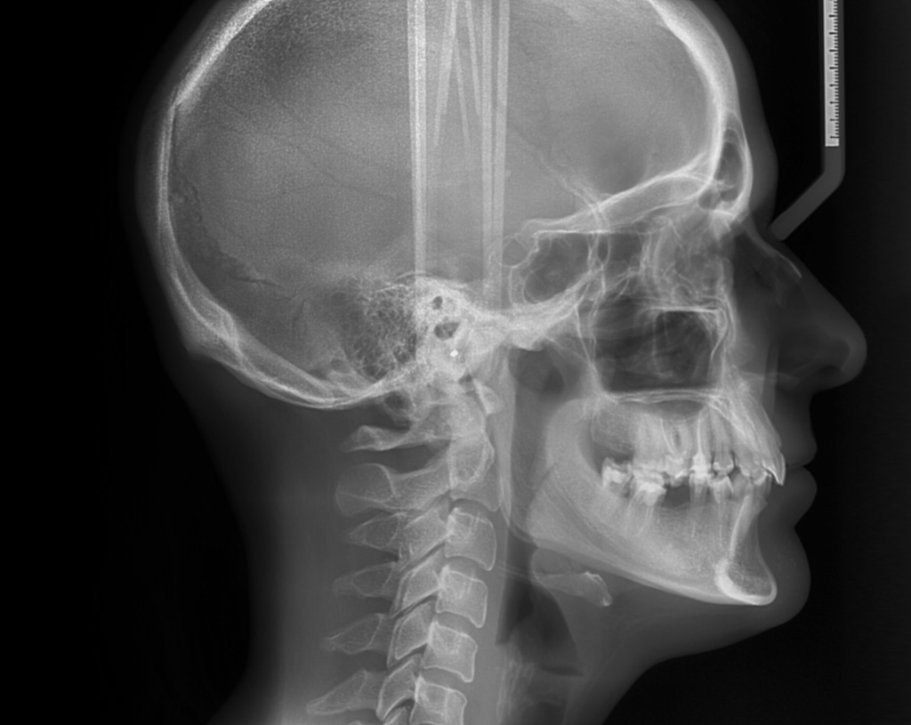 cephalogram-x-ray of the facial structures