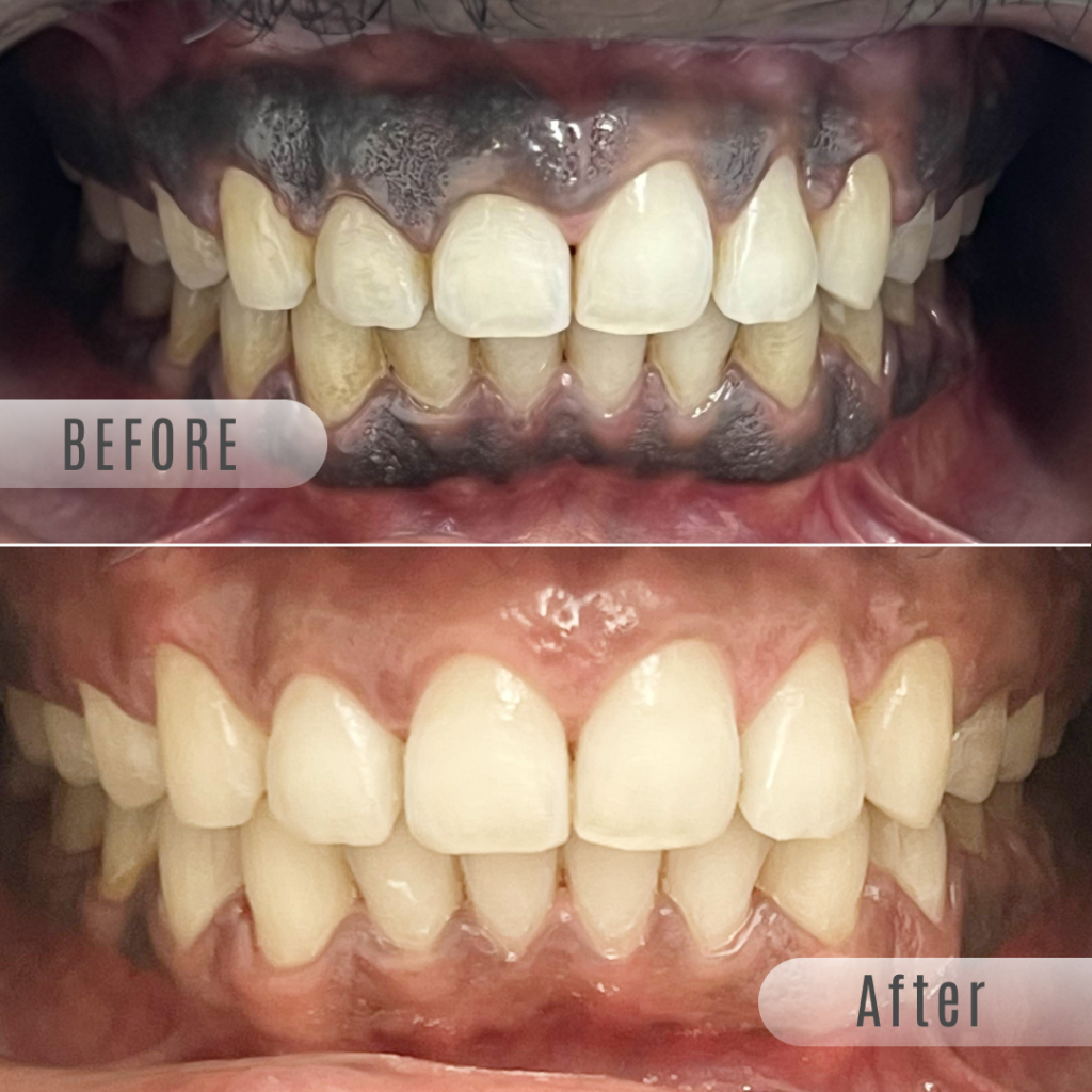 Before and after picture of Laser Gum Depigmentation