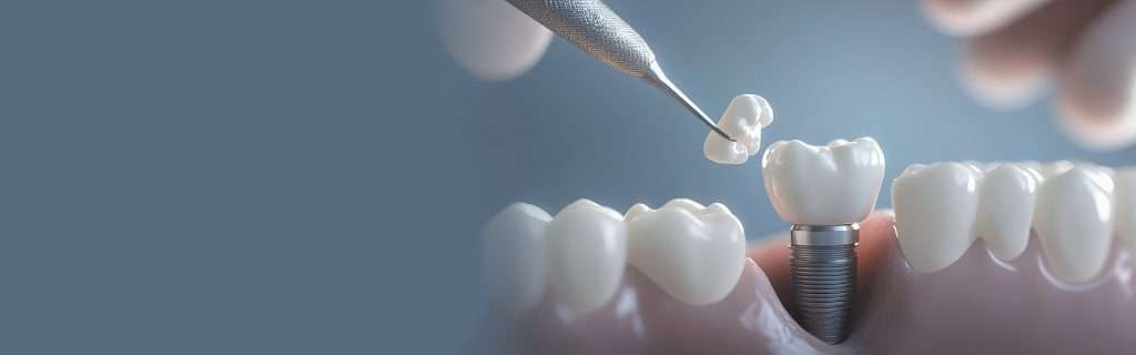 Dental Implants